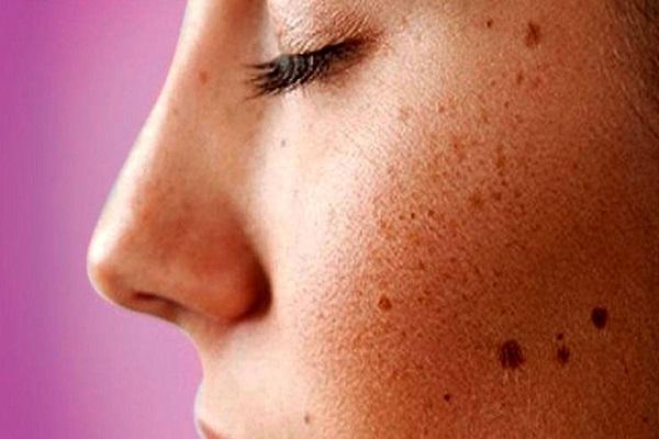 7 عاملی که باعث بروز لکه های تیره روی پوست می گردد